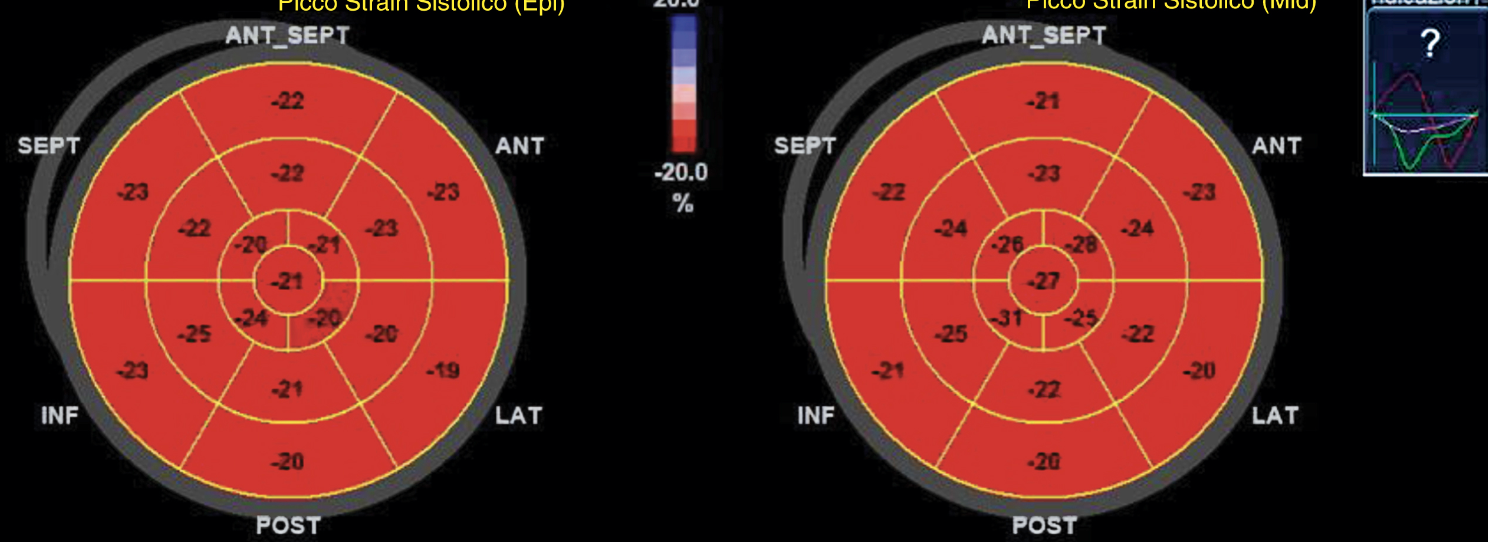 Strain Miocárdico